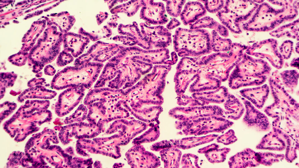 New research casts doubt on a cornerstone of thyroid cancer treatment